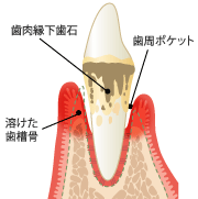歯肉の病気